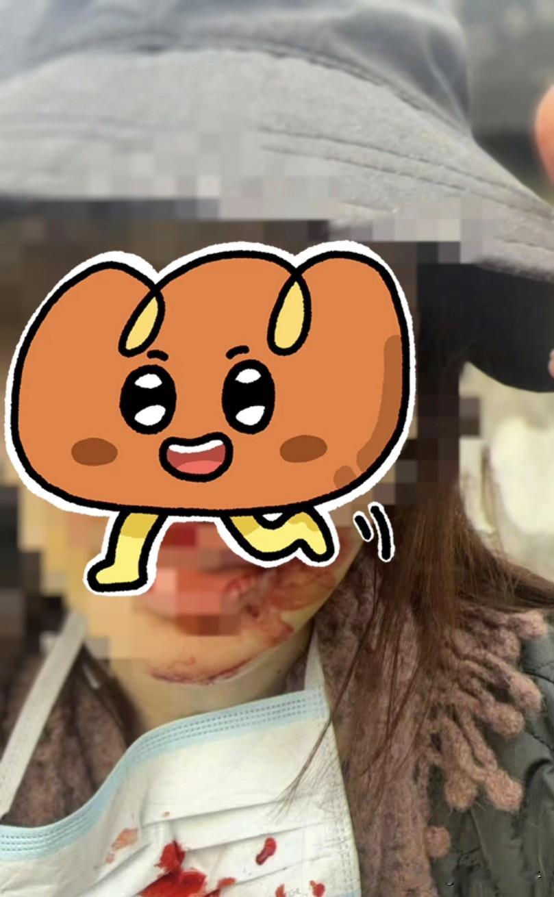 难怪金晨驾车肇事后着急离开，原来面部受伤如此严重！
1月30日，对于网上爆料肇事