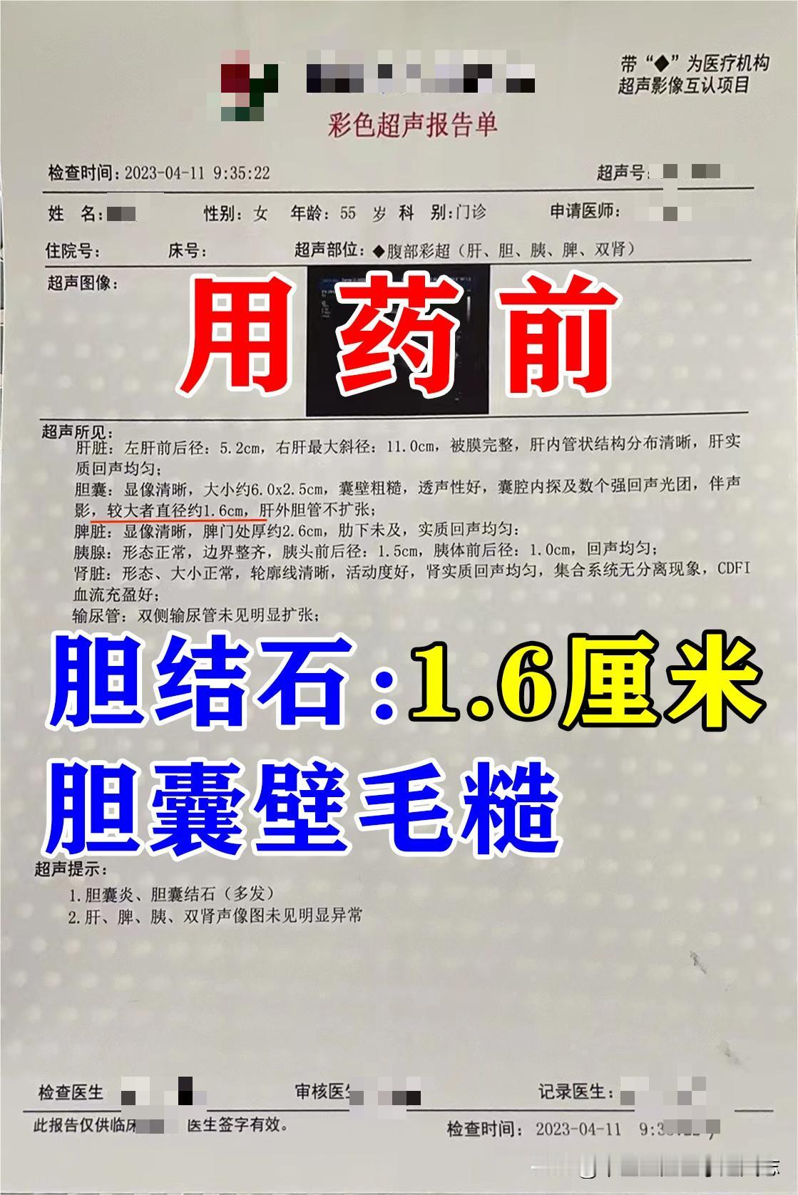 孙女生是之前做过保胆取石，之后又复发了，复发的时候检查显示多发胆结石，较大者1.