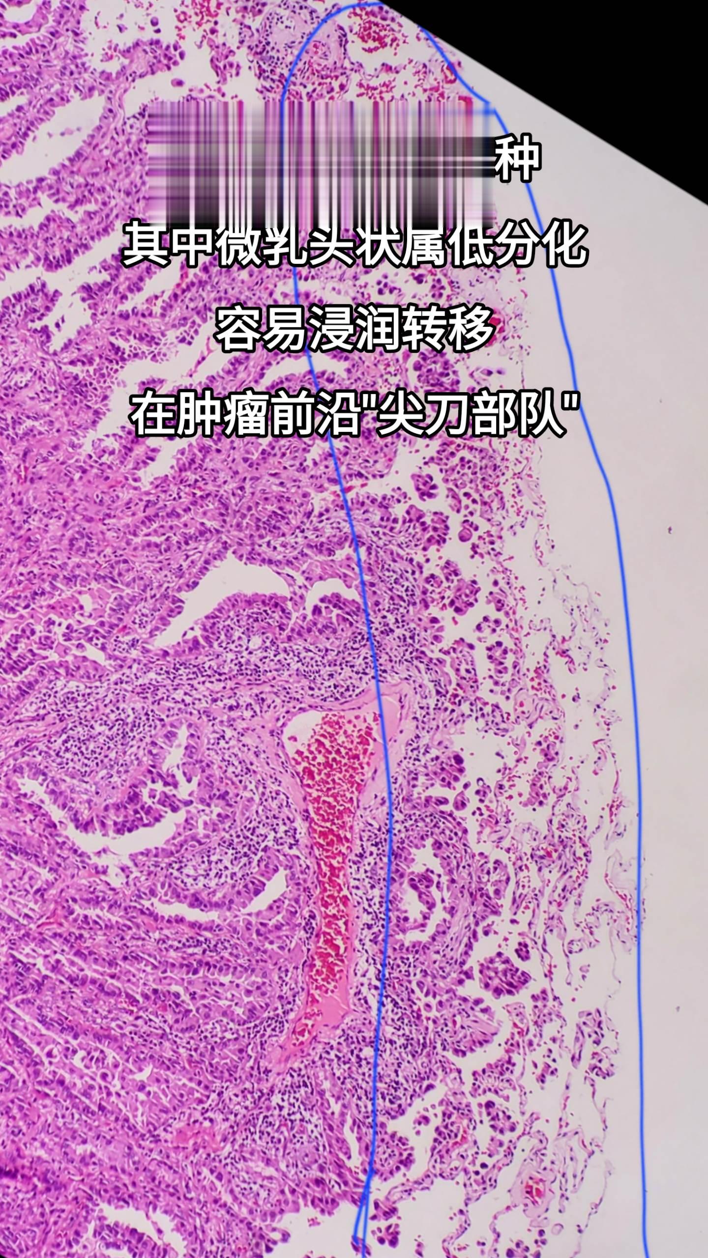 肺腺癌