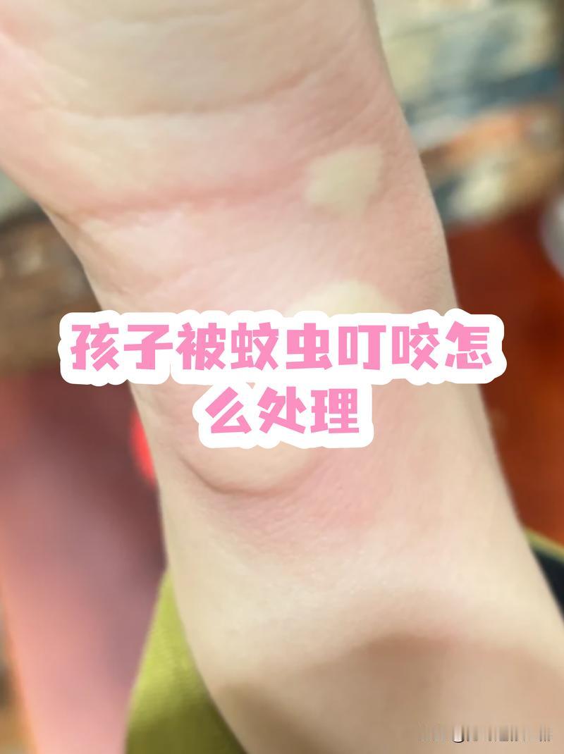 蚊虫叮咬后涂肥皂水有用吗，怎么处理消肿最快？首先，肥皂水对刚被咬时有一定缓解作用