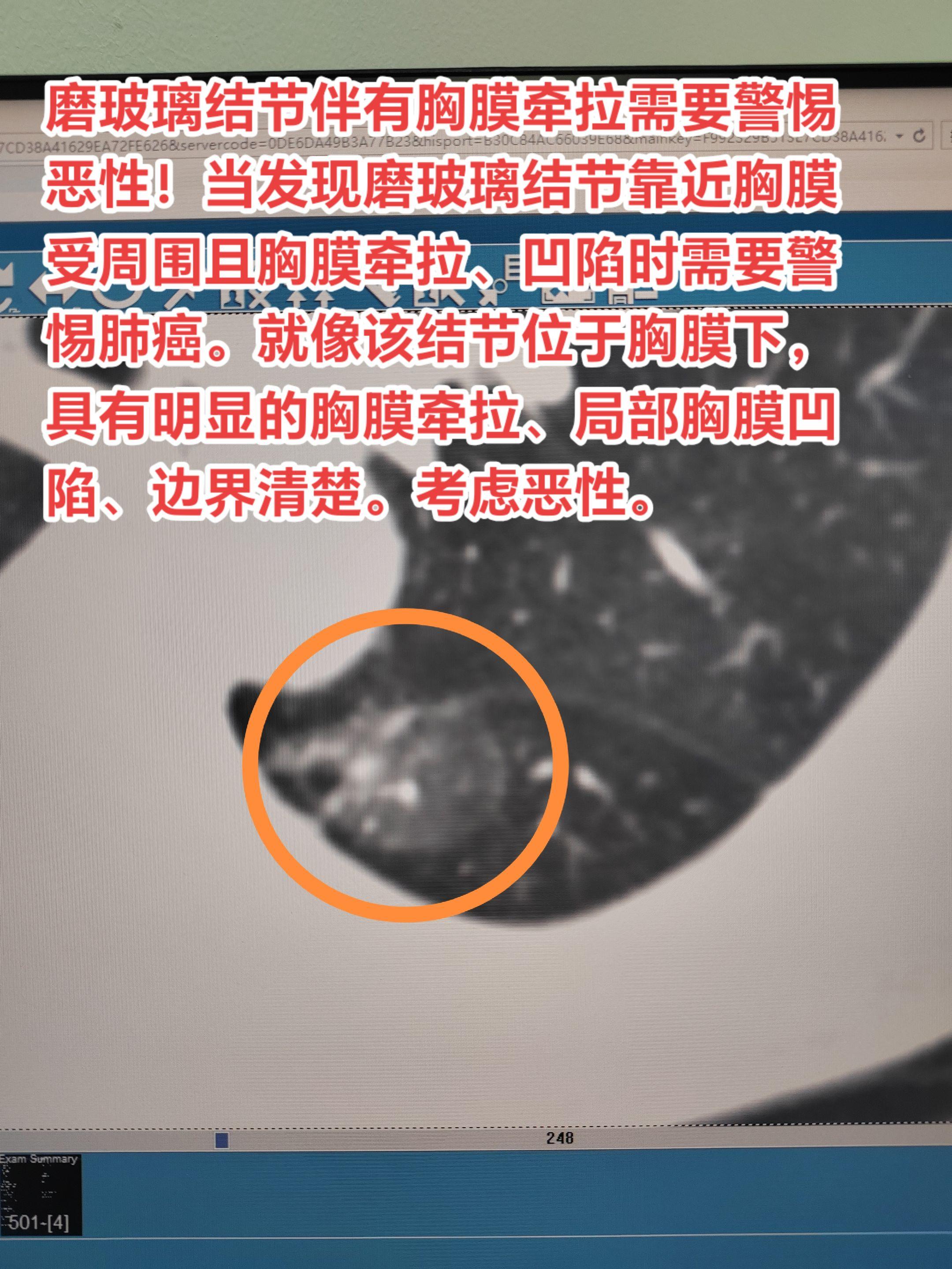 磨玻璃结节伴有胸膜牵拉需要警惕恶性！当发现磨玻璃结节靠近胸膜受周围且胸...