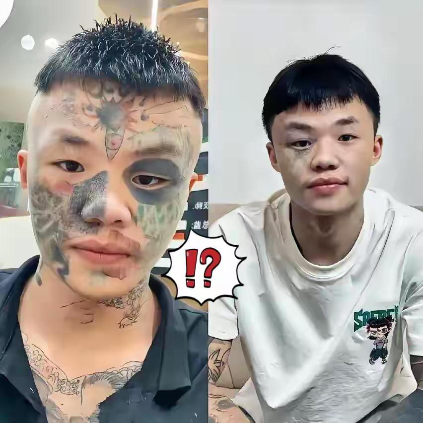 广东男孩夏朝勇再洗两次，脸上纹身就没了！可这罪，全是13岁那阵“一时冲动”欠下的