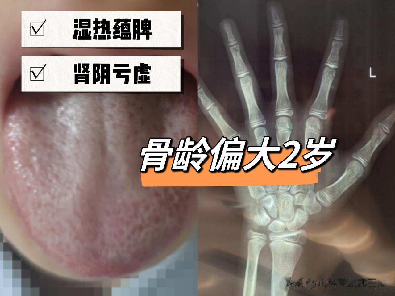 孩子到底还能长多少，骨龄是不会说谎的！
11岁男孩，骨龄13岁，中医干预7个月追