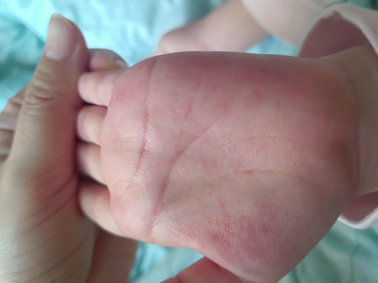 女儿的手又开始痒了！上个星期去东区省儿童医院看了，医生说是湿疹，给开了两个药膏，