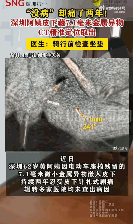 无病一身轻！深圳六旬阿姨被剧痛折磨两年，多家医院查不出病因，CT揪出皮下7.1毫