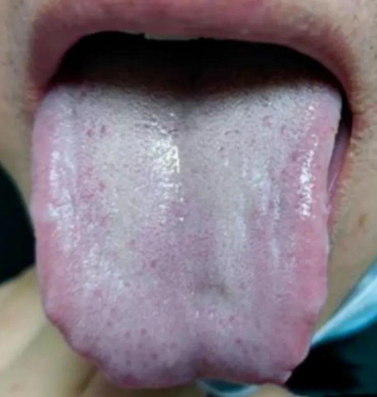 舌象出现这种症状 不及时调理 还在等啥

从舌象来看，舌中凹陷、白腻苔，以及舌边