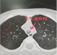 凌晨三点东莞两岁男童突发气喘送医，起初家长否认呛过异物。医生结合体征高度怀疑气道
