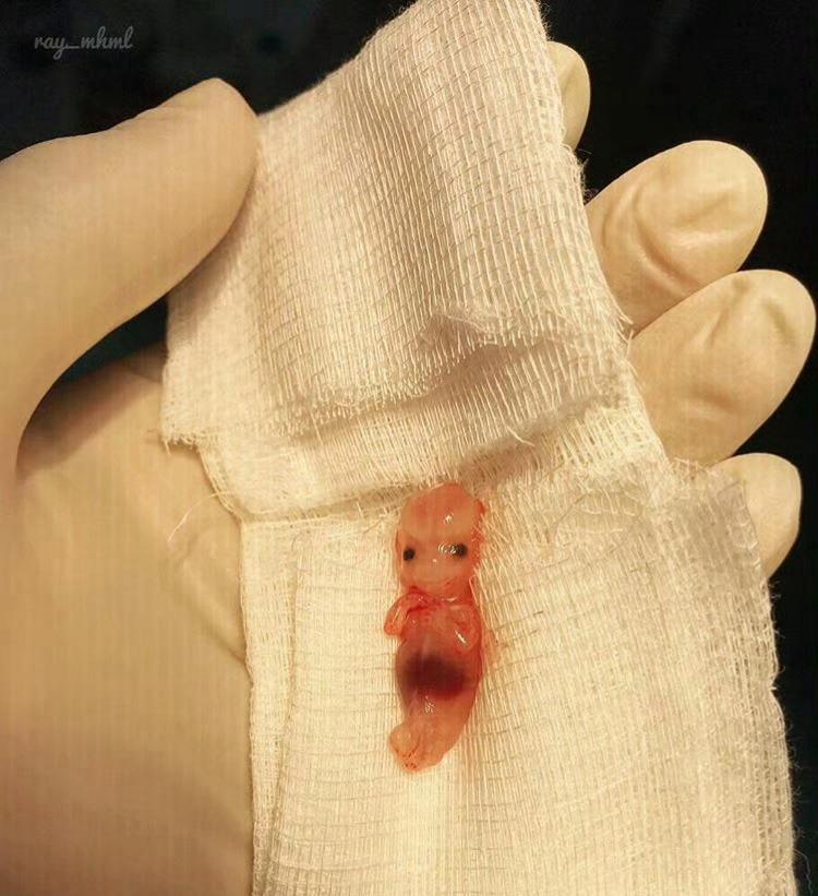 抽血报告上明晃晃的“HCG阳性”≠娃已经安稳落户，它只告诉你“身体里有胚胎分泌的