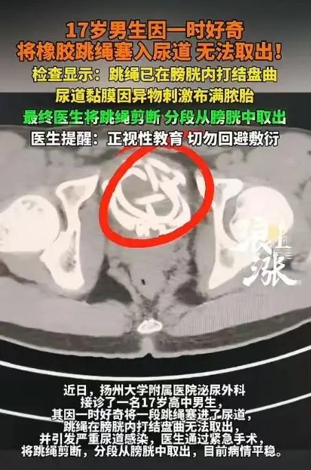 “小小年纪不学好！”江苏，一名17岁高中男生因为好奇，将橡胶跳绳插入尿道，不料，