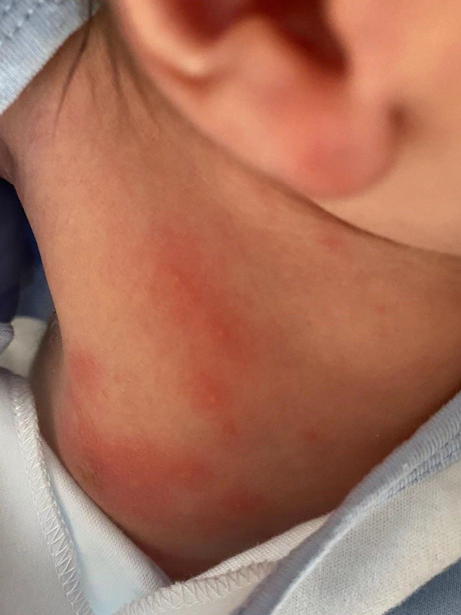 #宝妈咨询# 四月份健康群也有个新生儿毒性红斑的案例。健康群宝妈：大家好，宝宝出