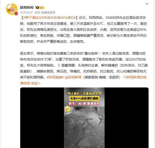 近日，陕西西安。35岁的郑先生饮酒后受凉发烧，他服用了两次布洛芬混悬液，第三天体