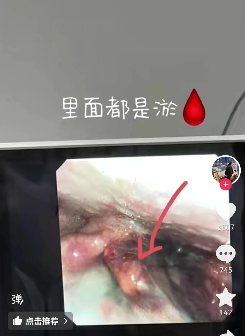 赵继伟妻子王君瑞忍不住了！心疼的发出赵继伟给喉咙做检查的片子，黑乎乎的一片都是淤