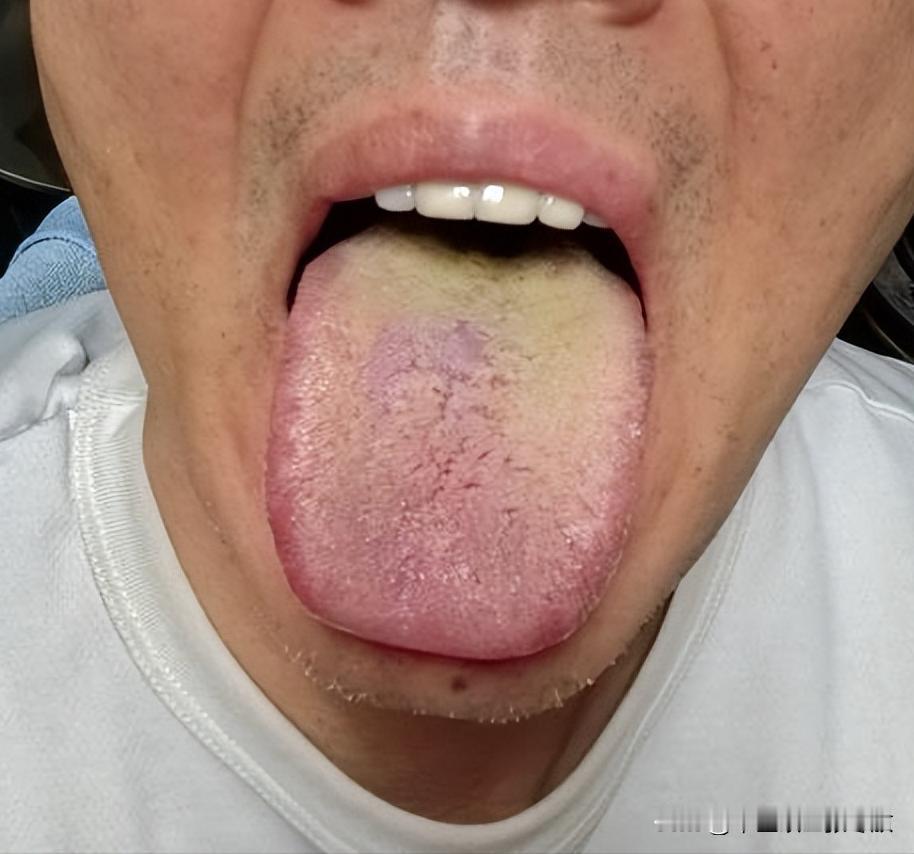 这大哥刚40出头，主诉：下身潮湿，异味大，男科更是。。。
自己也吃了点药，但是感
