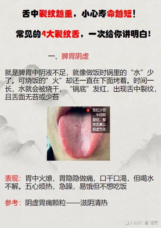 舌中裂纹越重，小心寿命越短！常见的4大裂纹舌，一次给你讲明白

一、脾胃阴虚
原