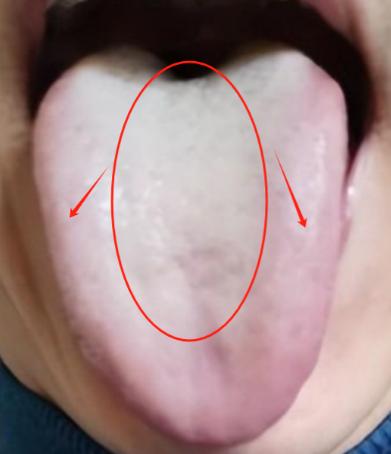 舌苔厚的肝郁舌，谨记：先化痰湿，再疏肝，否则前功尽弃

1.先化痰湿——二陈汤