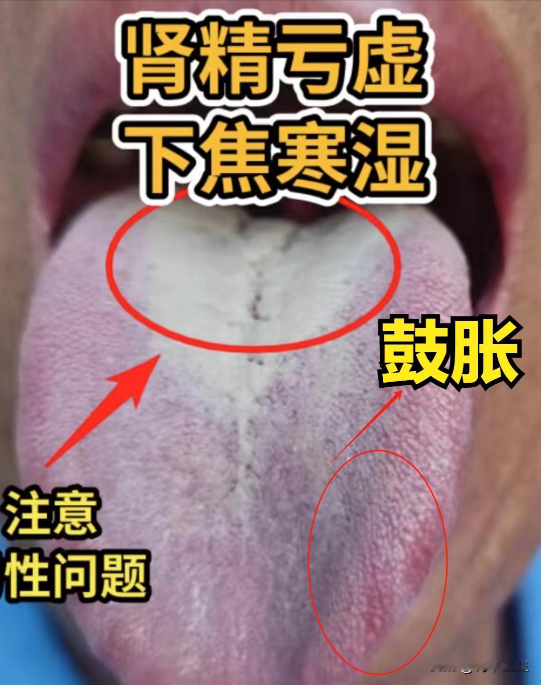 舌头长这样，怪不得五子衍宗没效果，有痰湿和肾精不足的朋友注意了，你这样吃只会越补