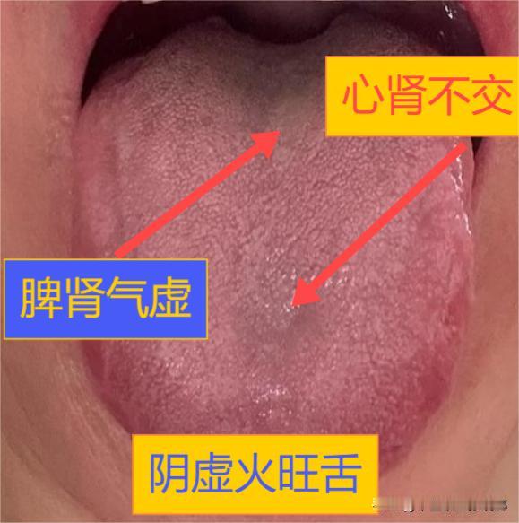 这种舌象，最适合用六味地黄丸，但是忽略了这一小步，就有可能前功尽弃！
自制力太差