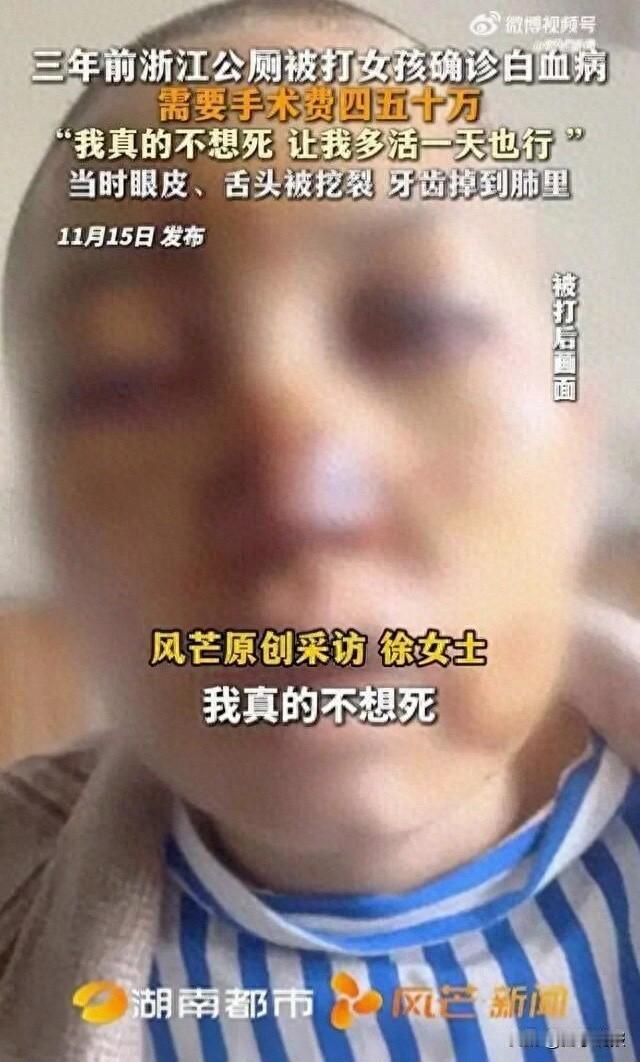 浙江公厕被陌生男子暴打20分钟的女生确诊白血病：我确实不想死！[困]

三年前浙
