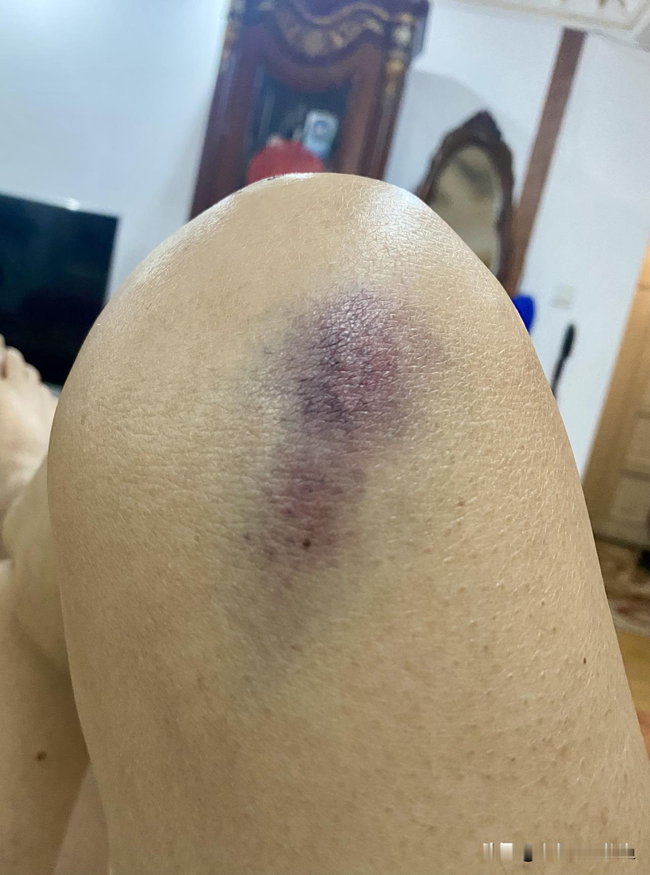 毁啦！落下一个毛病，虽然不算大，但一天天地让人很揪心。我的身上任何部位，只要碰一