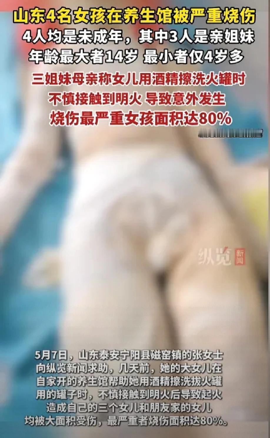 惨不忍睹！山东泰安4名未成年女孩，因火罐酒精爆燃被烧伤。
 
10岁女孩全身80