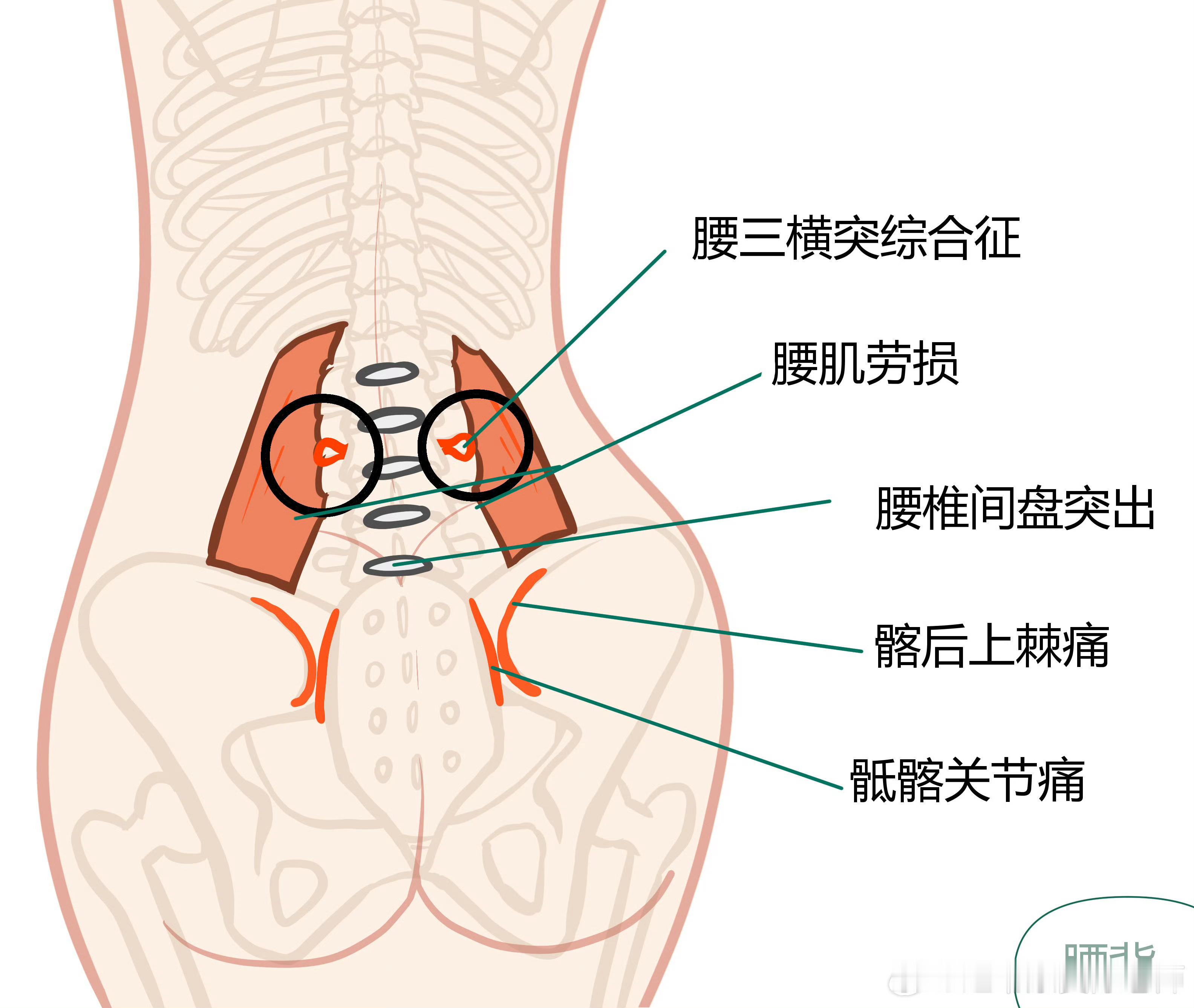 腰背疼痛自查攻略  腰肌劳损、腰椎间盘突出、骶髂关节、筋膜炎，这一直是大家的高频
