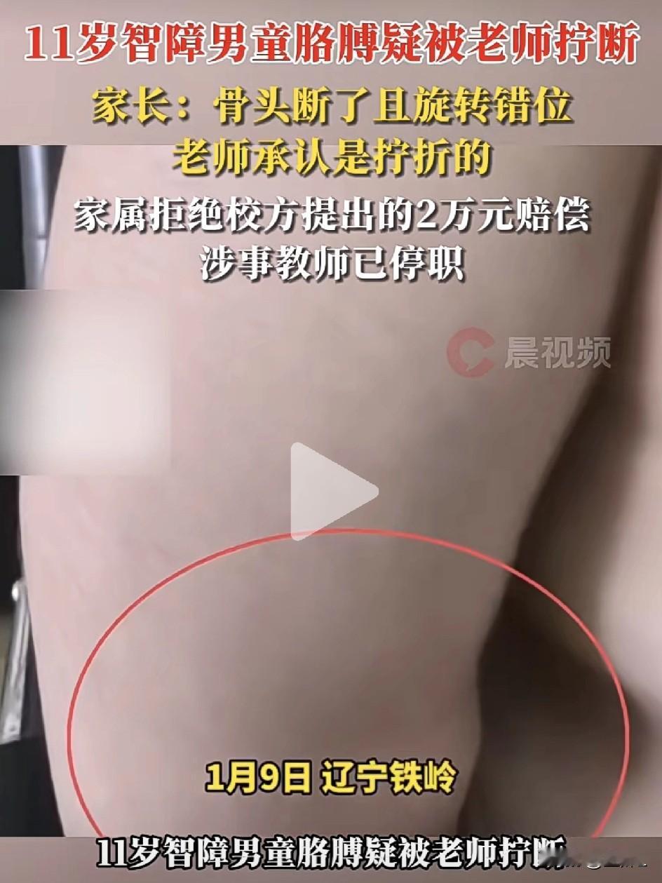 辽宁一康复中心老师疑拧断11岁残障男童胳膊！家长怒斥：2万就想打发？网友怒评：良