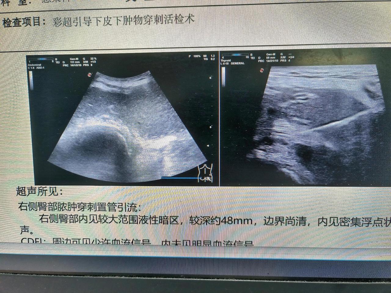 迷信“土方子”的人能有多奇葩？
最近朋友医生科室来了一个病人，诊断脓毒症，因为迷