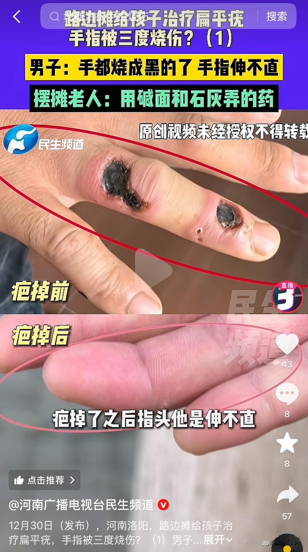 “这位父亲太大胆！”河南洛阳，一男子的儿子手上长了扁平疣，他带儿子来到路边摊医治