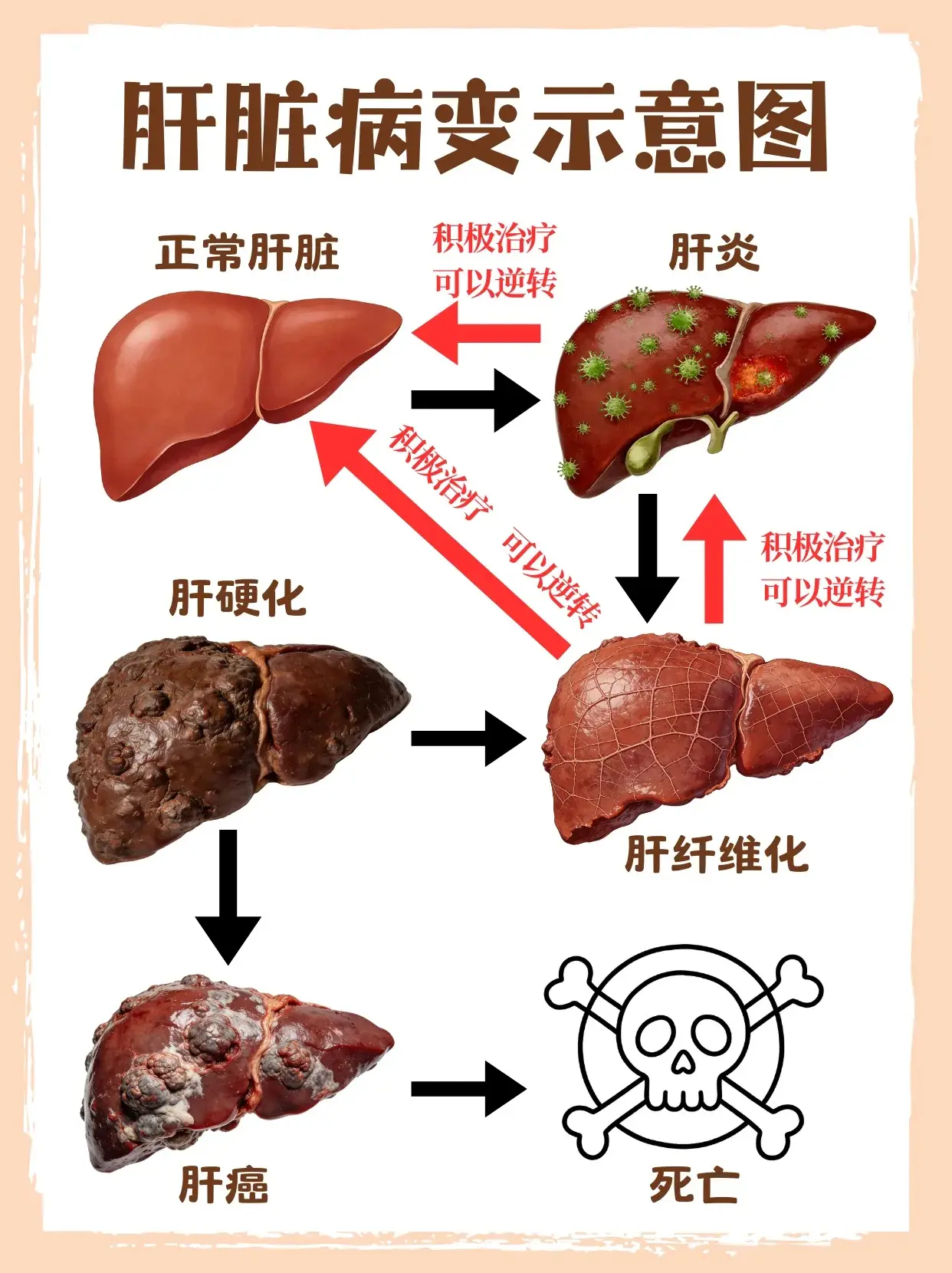 乙肝 肝硬化 肝癌 肝纤维化 肝炎