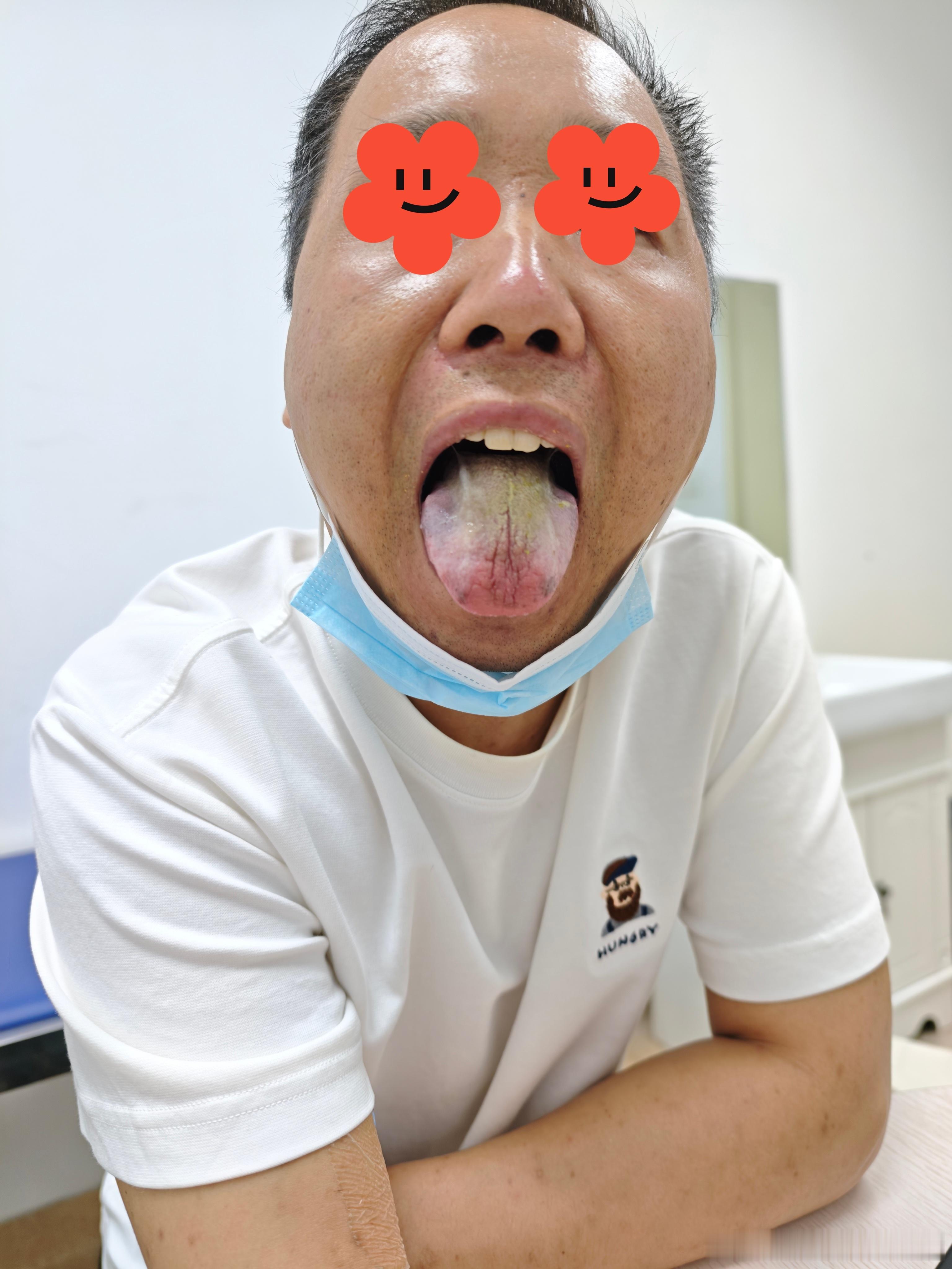 我的门诊故事 肠癌患者，口干粘腻，饮食难以下咽。第一印象想到王三虎教授的“燥湿相