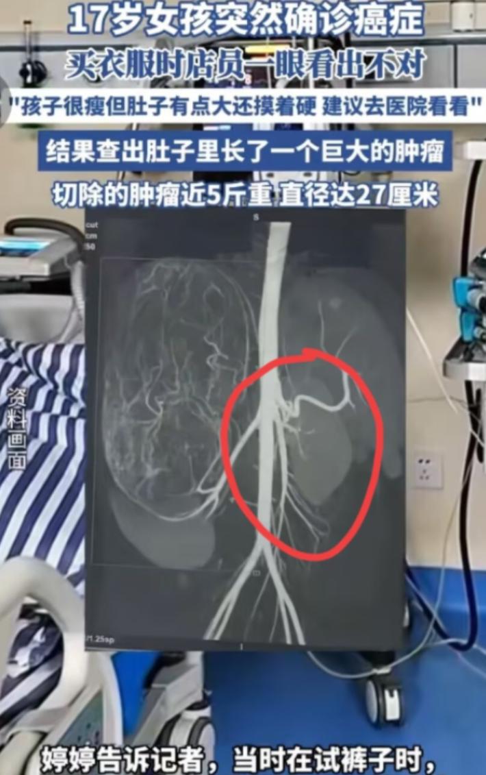 17岁肚子大得像怀胎十月，

能吃能睡却长出27厘米肿瘤，

它到底怎么躲过所有