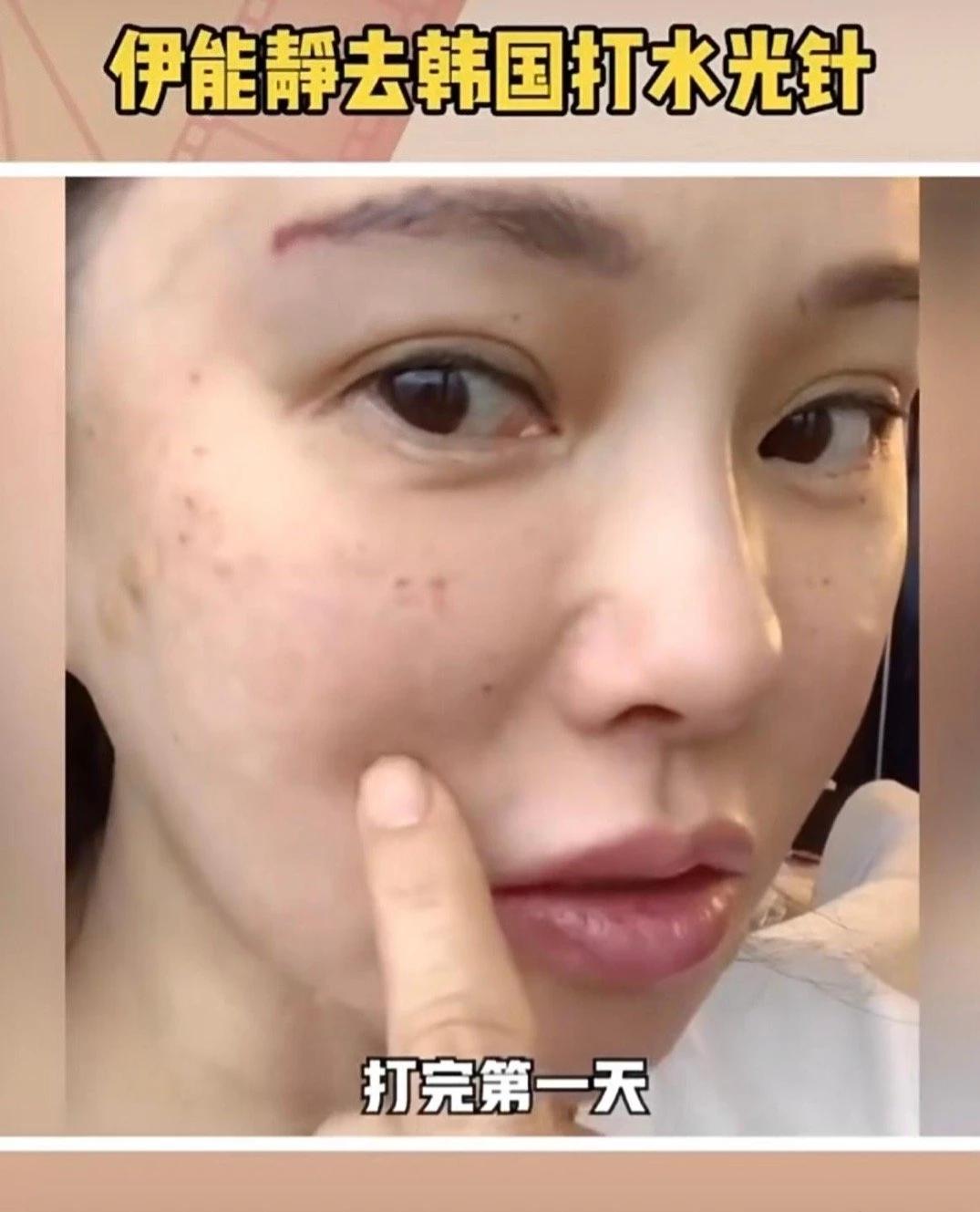 伊能静真是够坦诚的，她直接公开了自己去韩国打针的视频。她还说打针那滋味，哎哟，疼