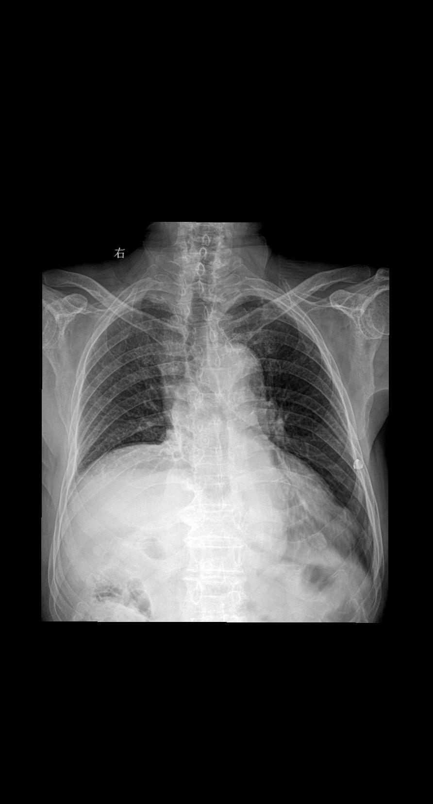 男 89岁 胸闷 咳嗽就诊