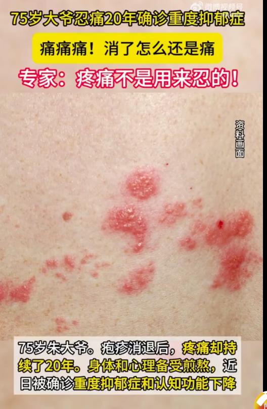 忍痛20年，竟忍出重度抑郁！近日有报道声称，浙江宁波75岁朱大爷因带状疱疹后遗神