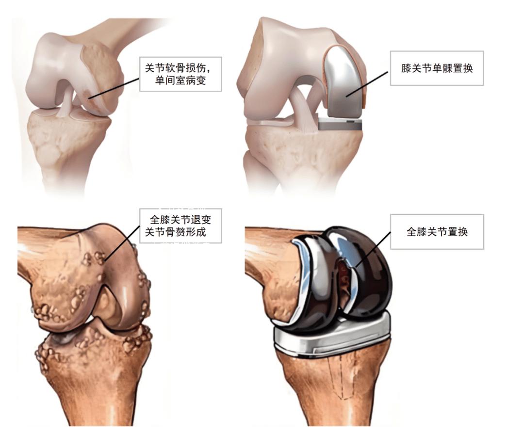 得了骨关节炎，什么时候该考虑膝关节置换？很多朋友都被这个问题难住🤔
其实核心判