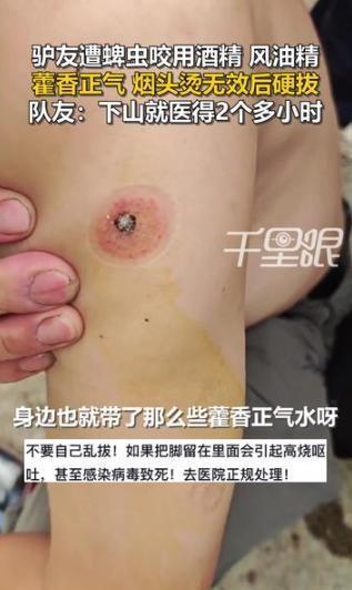 太可怕了！6月15日，安徽宣城一男子徒步至半山腰时，不幸被蜱虫紧紧咬住。因下山就