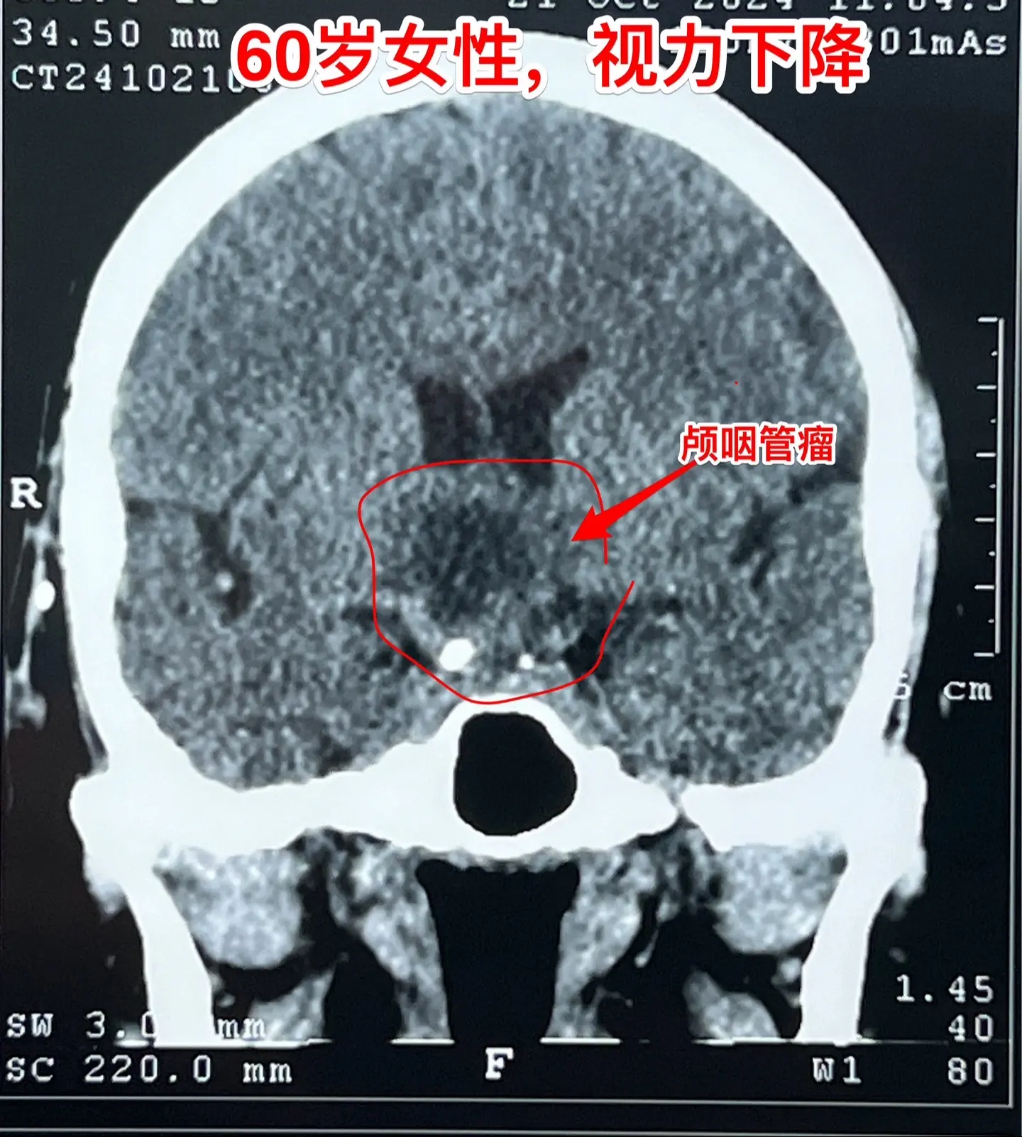 60岁连云港市的老人视力下降⬇️。老人自幼右眼受伤了，右眼视力属于无效...