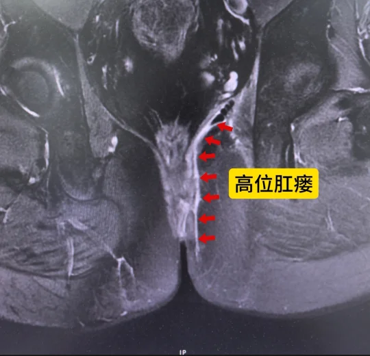 为什么肛瘘要做磁共振？