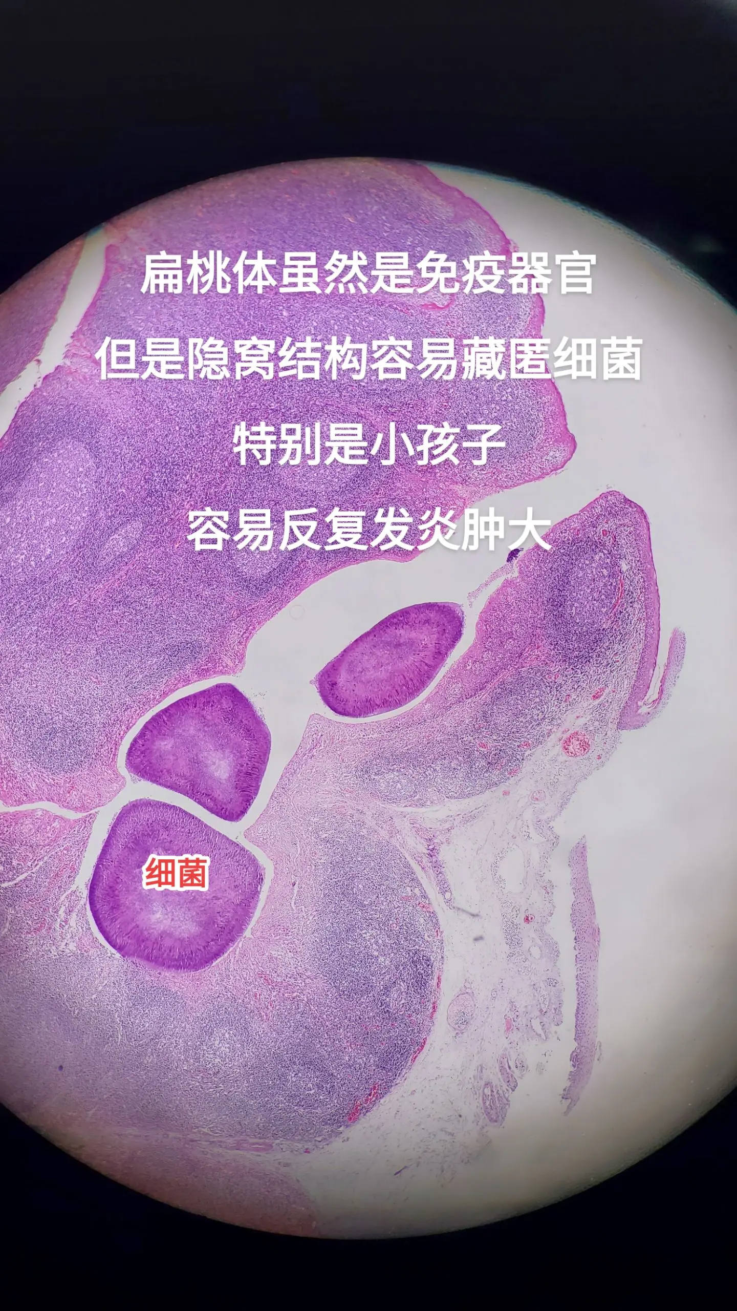 扁桃体炎