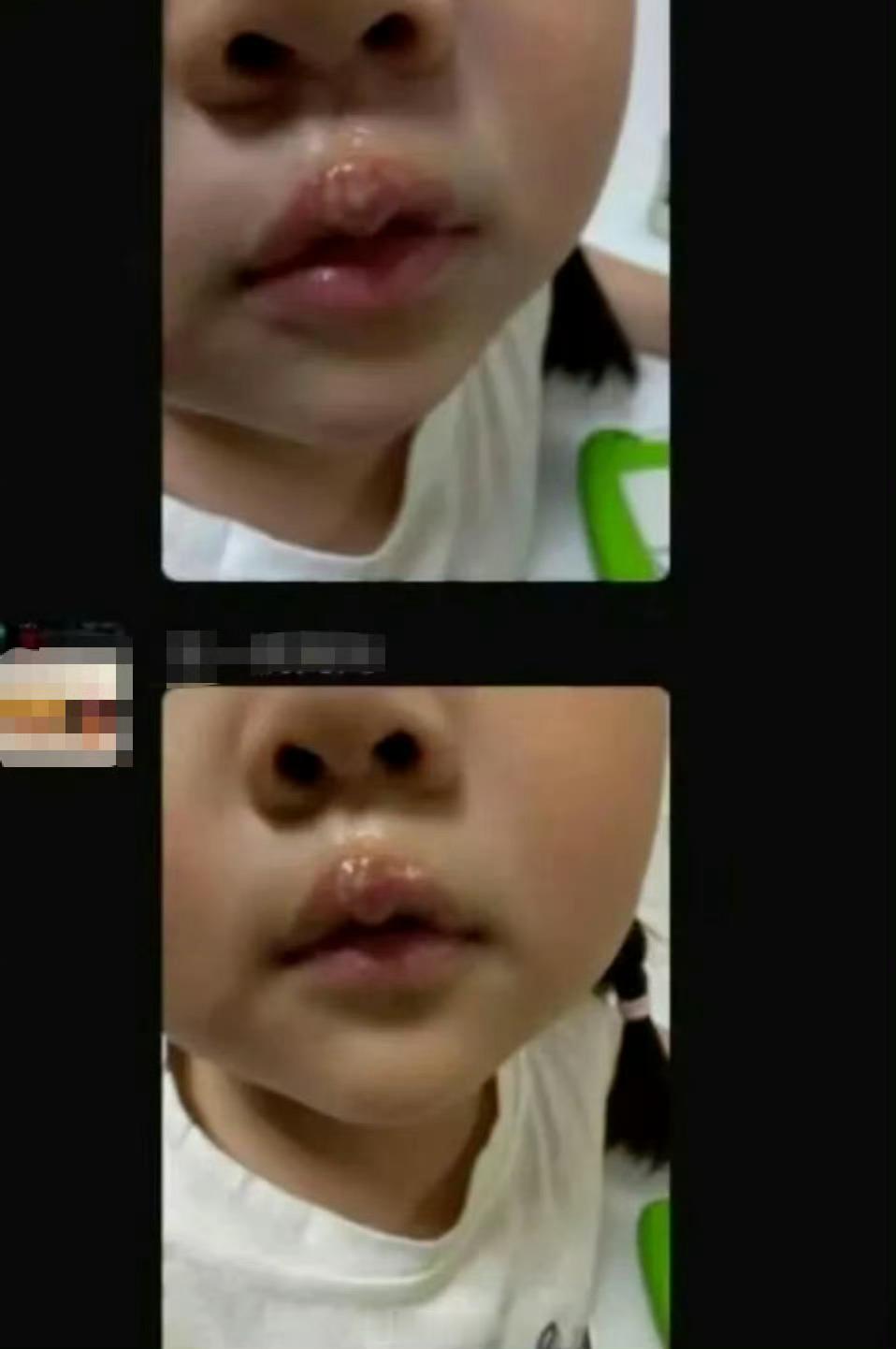 【江苏一女童被老师用热熔胶烫嘴幼儿园老师用热熔胶烫女童嘴被停职】近日，有江苏徐州