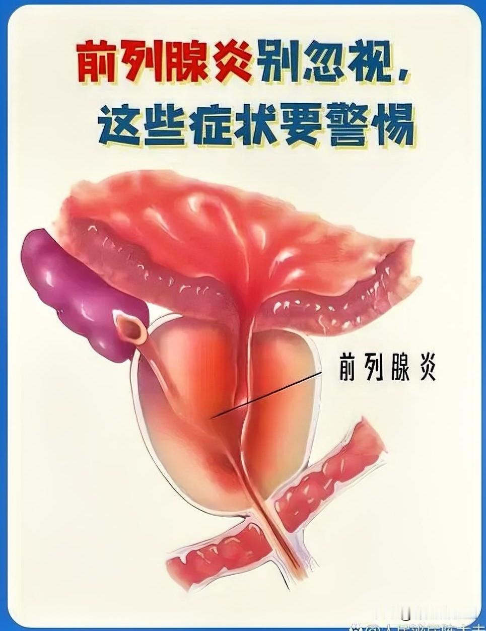 前列腺炎虽说不伤命，但很痛苦，也很麻烦。特别是旅游坐车，尤其是坐长途汽车，简直是
