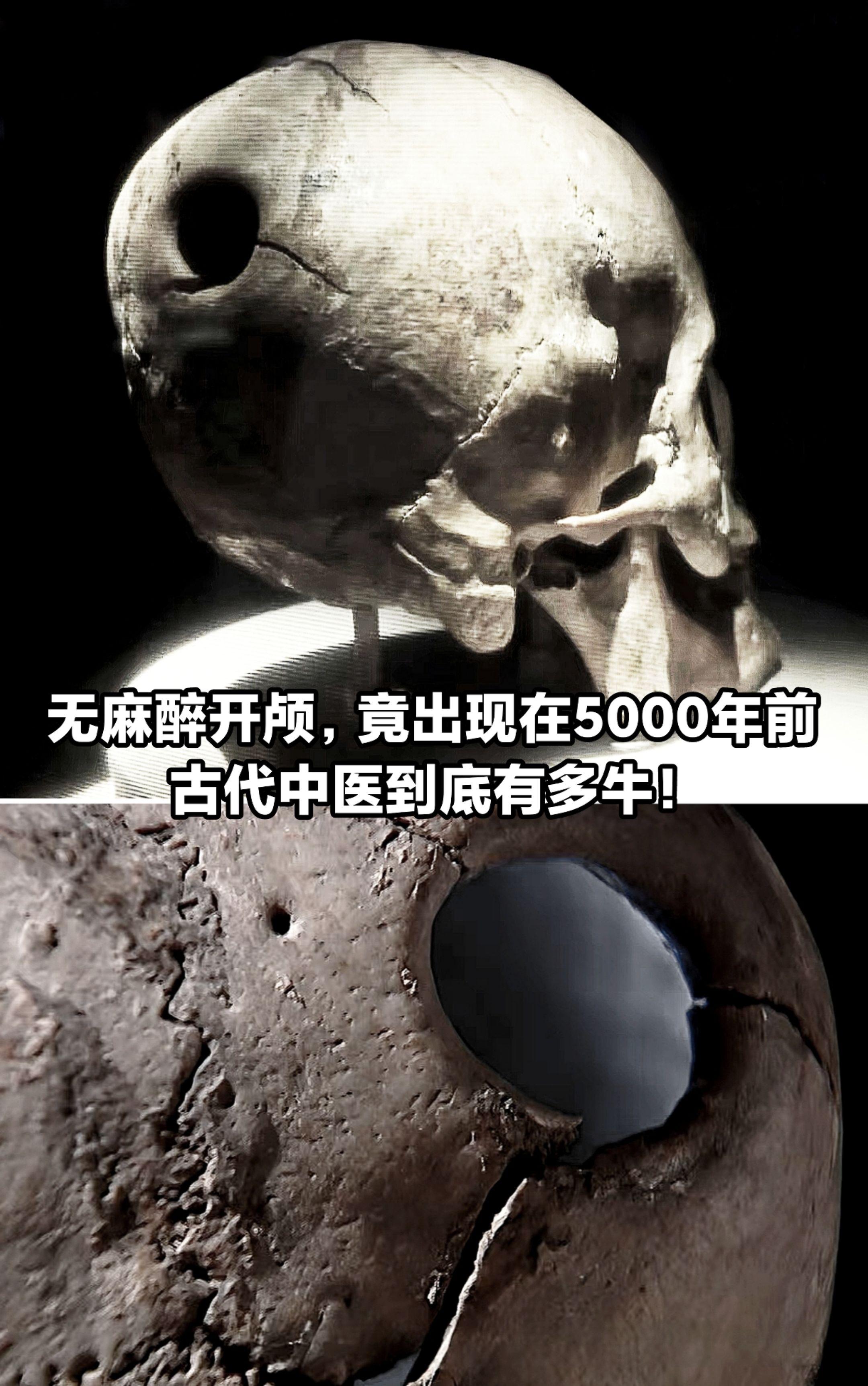 无麻醉开颅手术，竟出现在5千年前。