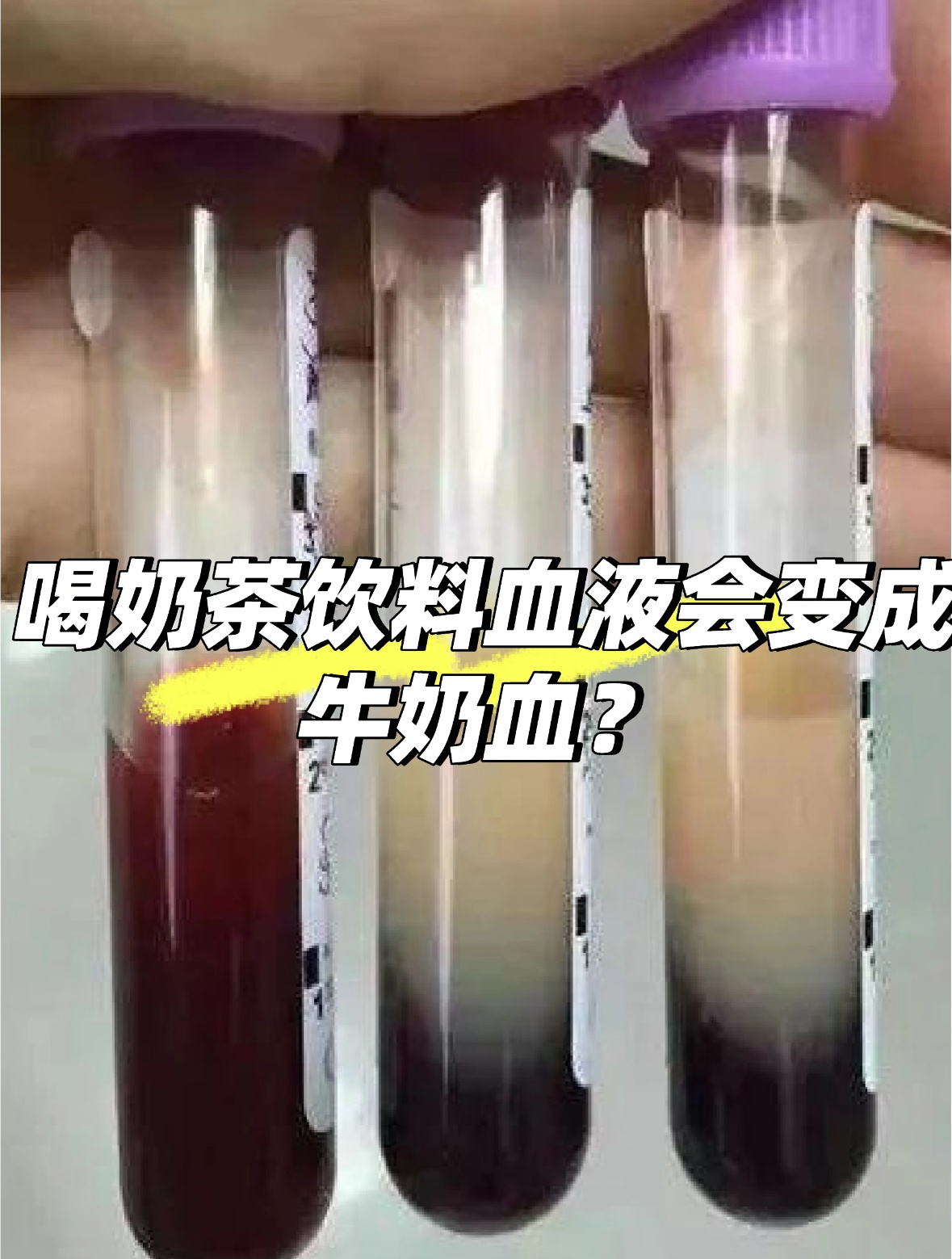 奶茶病也算是富贵病了，一天3倍可得不少钱[doge]虽说碳基生物无拒绝糖分摄入，