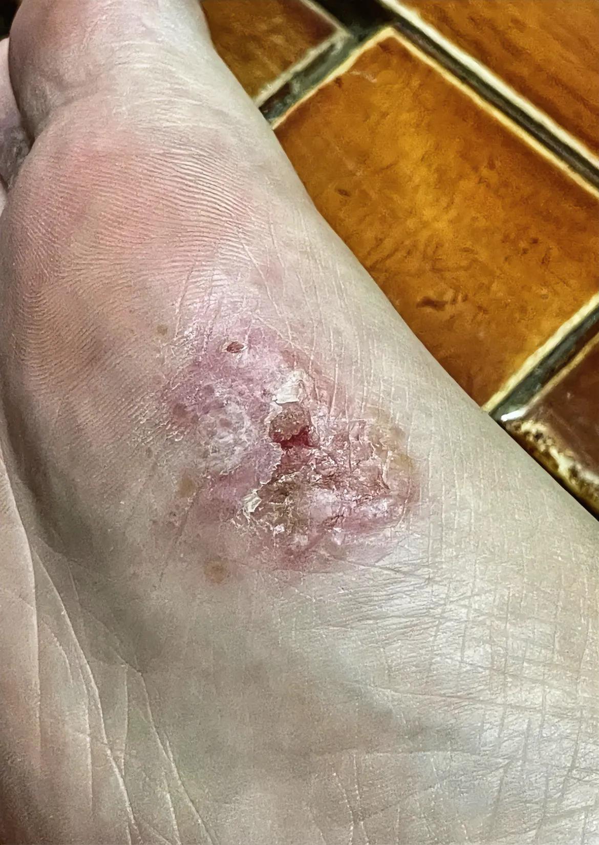 奇痒无比，还经常流血不止，看上去怪瘆人的！

这只脚是我一位女同事的，说来挺奇怪