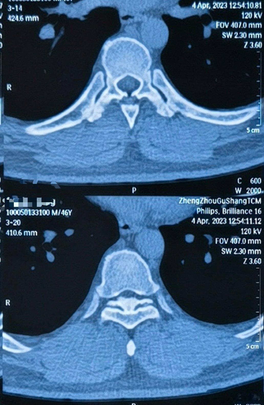 我有一个特殊的病人，40几岁一男的，特别倒霉。你看图里，这是胸椎黄韧带钙化，上面