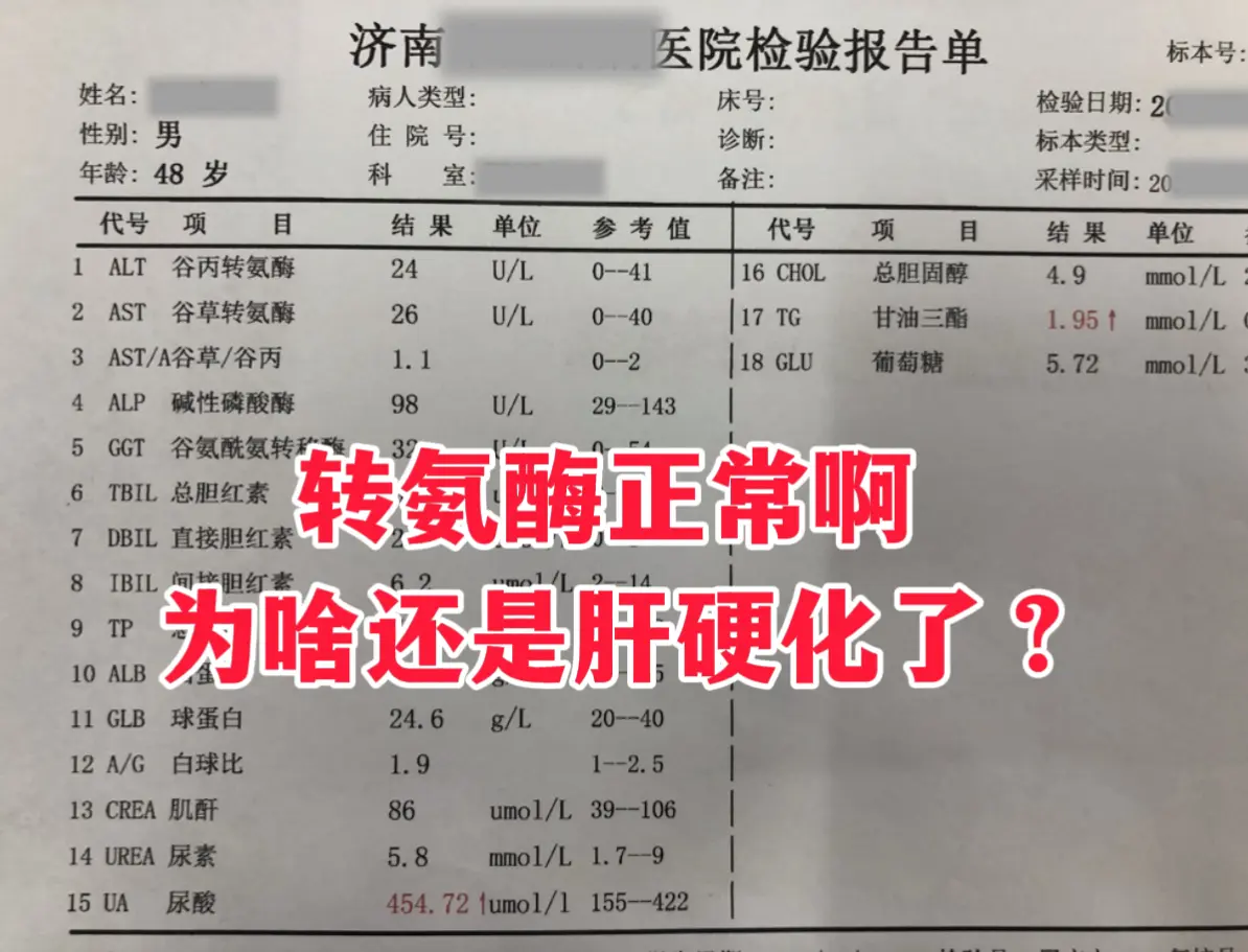 “我转氨酶一直都是正常的，怎么就查出肝硬化了？” 这是山东本地的刘先生...