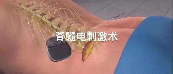 脊髓起搏器-单侧脊髓电刺激术。脊髓电刺激术应该范围较广，可用于昏迷促醒、疼痛、步态障碍等
