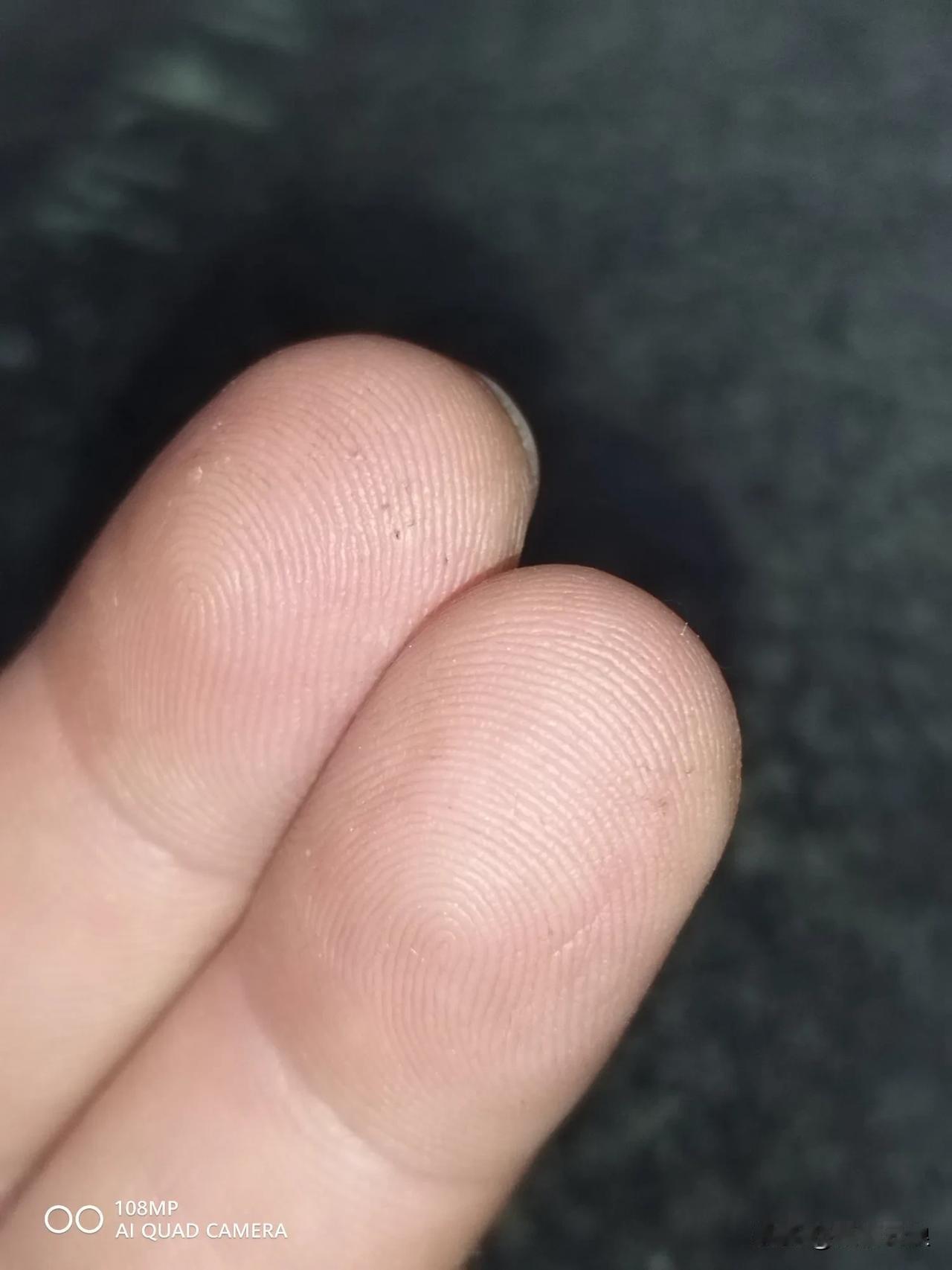 28岁确诊二型糖，一晃眼，40岁了。
完结了6本小说，才发现忘记是糖人了。
赶紧