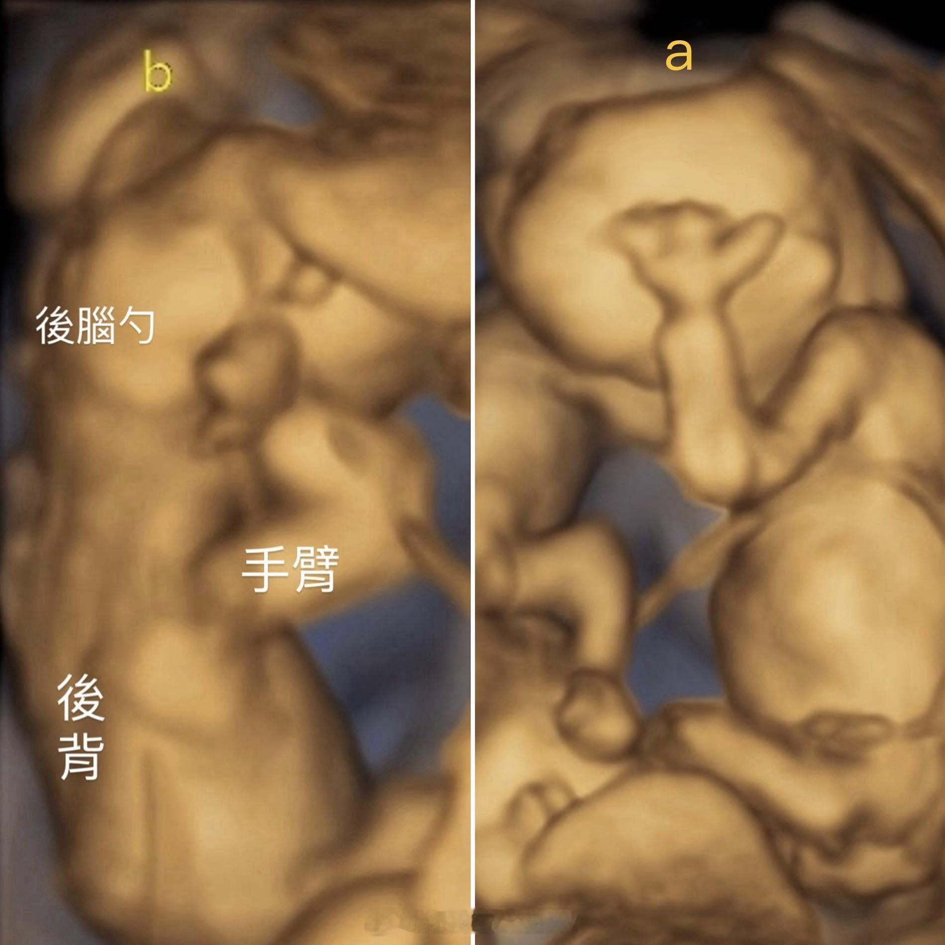 台湾深绿网红“鸡排妹”郑家纯，怀了个双胞胎。近期的照片孕味十足。她是2015年爆