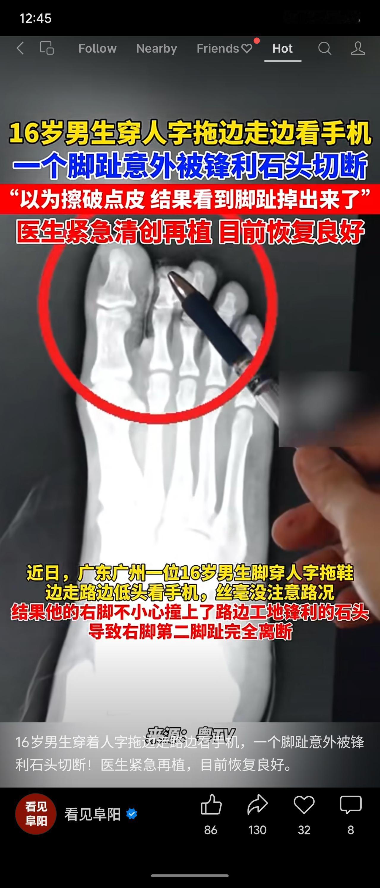 广东广州一名16岁男生穿人字拖低头看手机，右脚不慎撞上工地锋利石头，导致第二脚趾
